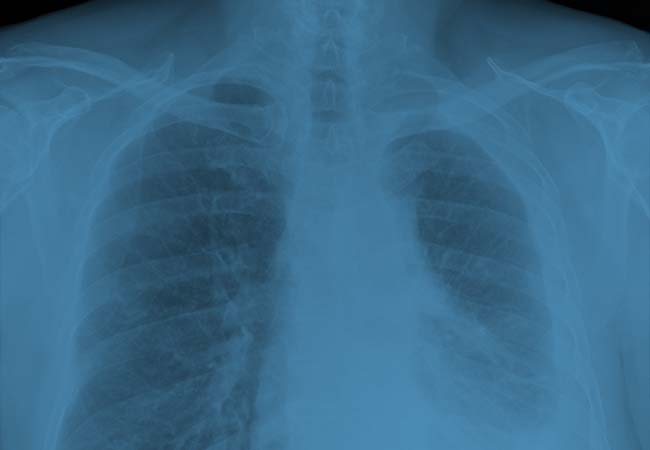 pa-mesothelioma-page